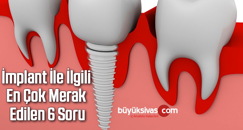 İmplant İle İlgili En Çok Merak Edilen 6 Soru