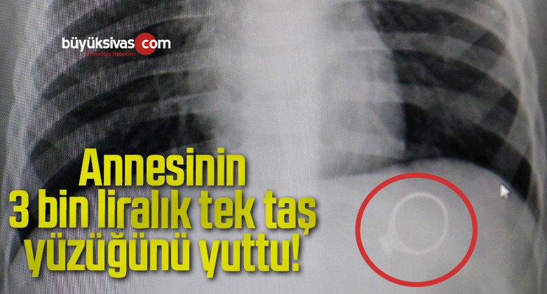 Annesinin 3 bin liralık tek taş yüzüğünü yuttu