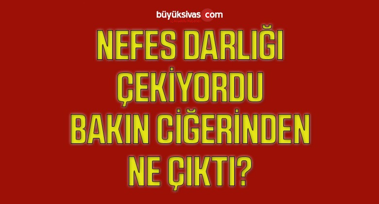 Nefes Darlığı ve Şiddetli Ağrı Çeken Hastanın Ciğerinden Arnavut Biberi Çıktı