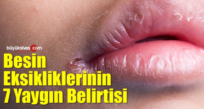 Besin eksikliklerinin 7 yaygın belirtisi