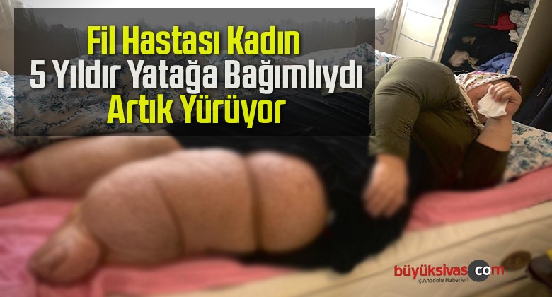 Fil Hastası Kadın 5 Yıldır Yatağa Bağımlıydı, Artık Yürüyor