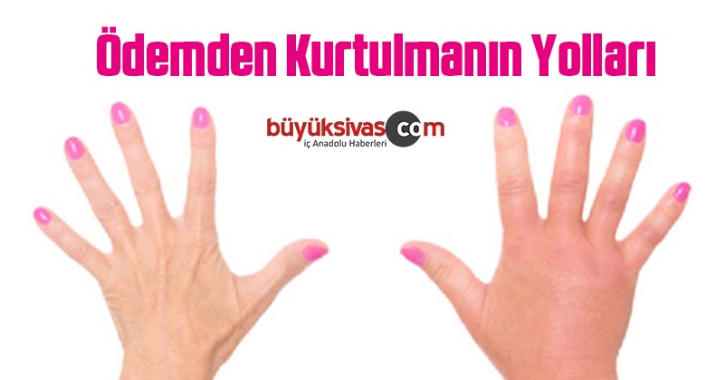 Ödemden Kurtulmanın Yolları