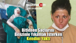 Saçlarını Benzinle Yıkarken Kendini Yaktı! Tedavi Olmak İstiyor