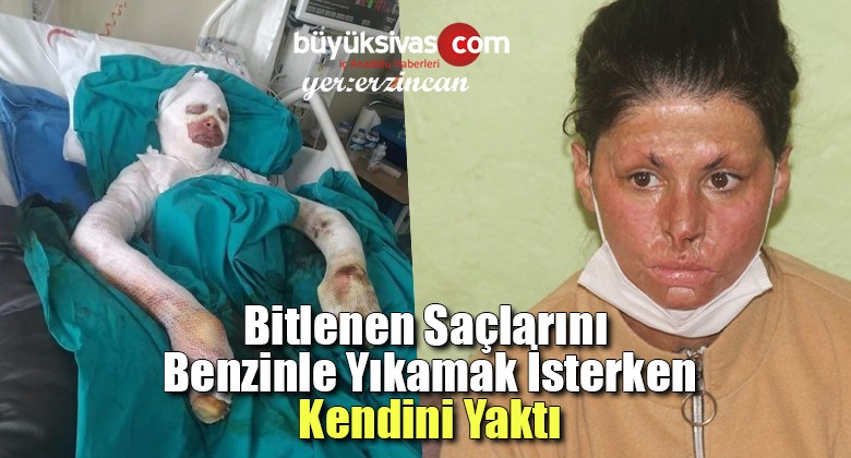 Saçlarını Benzinle Yıkarken Kendini Yaktı! Tedavi Olmak İstiyor