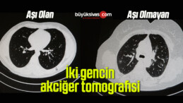 Aşılı ve aşısız korona olan 2 gencin akciğer tomografisi korkunç gerçeği gözler önüne serdi