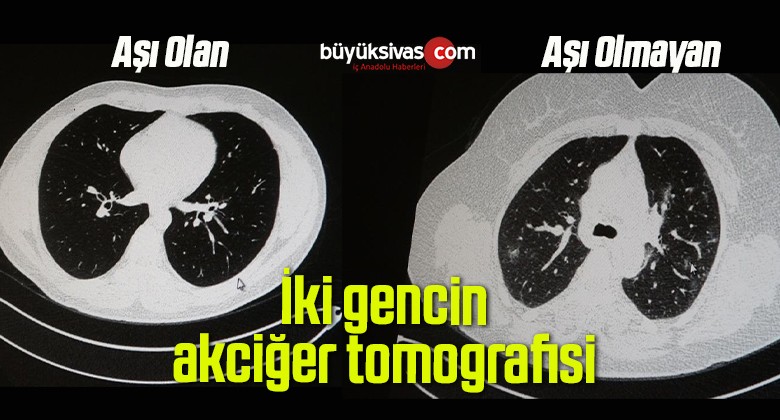 Aşılı ve aşısız korona olan 2 gencin akciğer tomografisi korkunç gerçeği gözler önüne serdi