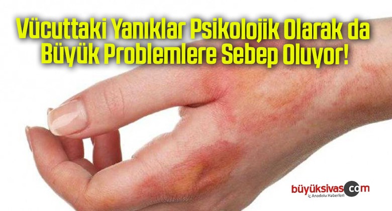 Vücuttaki Yanıklar Psikolojik Olarak da Büyük Problemlere Sebep Oluyor!