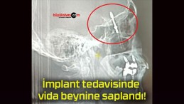 İmplant tedavisinde vida beynine saplandı!