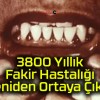 3800 Yıllık Fakir Hastalığı Yeniden Ortaya Çıktı!