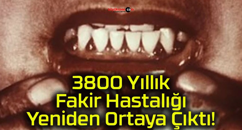 3800 Yıllık Fakir Hastalığı Yeniden Ortaya Çıktı!