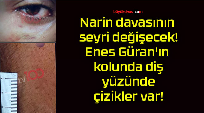 Narin davasının seyri değişecek! Enes Güran’ın kolunda diş, yüzünde çizikler var!